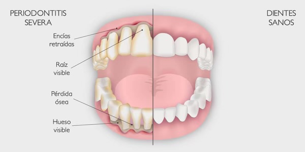 periodontitis vs boca sana Almendralejo 